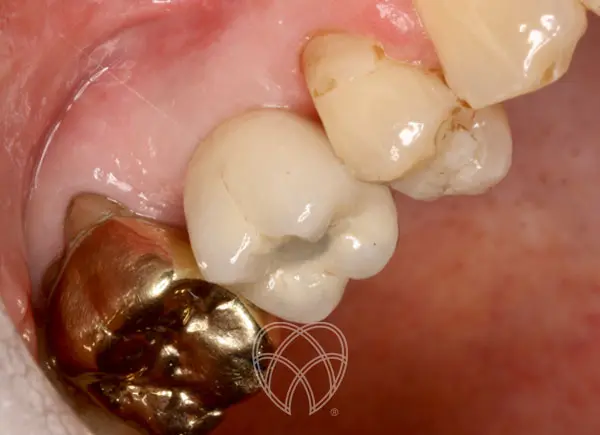 New Ash Green Dental - Implant After