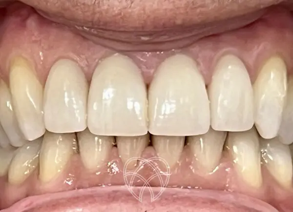 New Ash Green Dental - Invisaglign & Veneers After