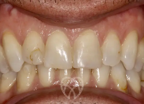 New Ash Green Dental - Invisaglign & Veneers Before