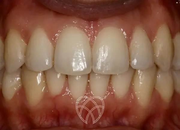 New Ash Green Dental - Invisalign After1