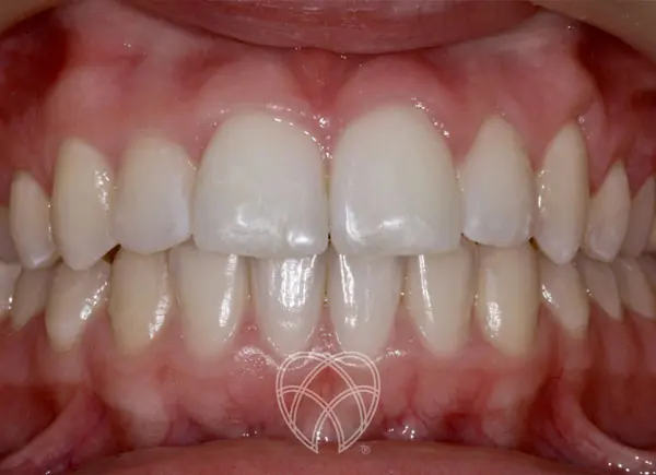 New Ash Green Dental - Invisalign After2