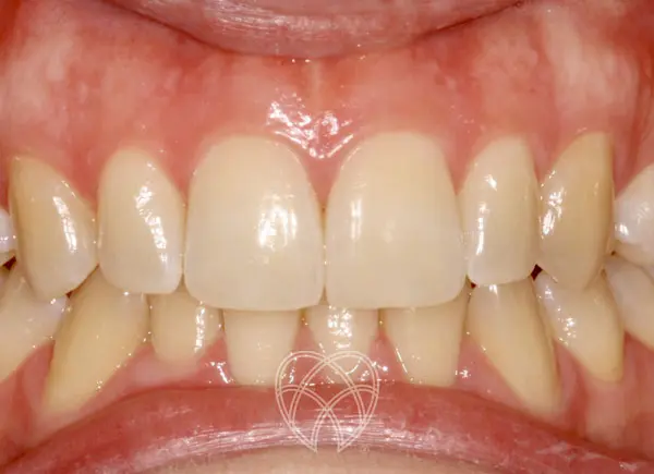 New Ash Green Dental - Invisalign After3