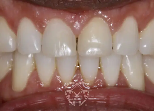 New Ash Green Dental - Invisalign After4