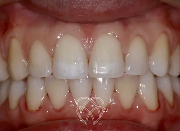 New Ash Green Dental - Invisalign After5