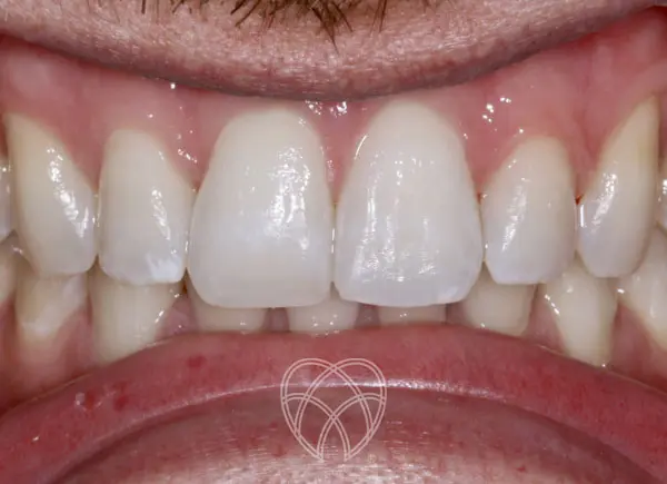 New Ash Green Dental - Invisalign After7