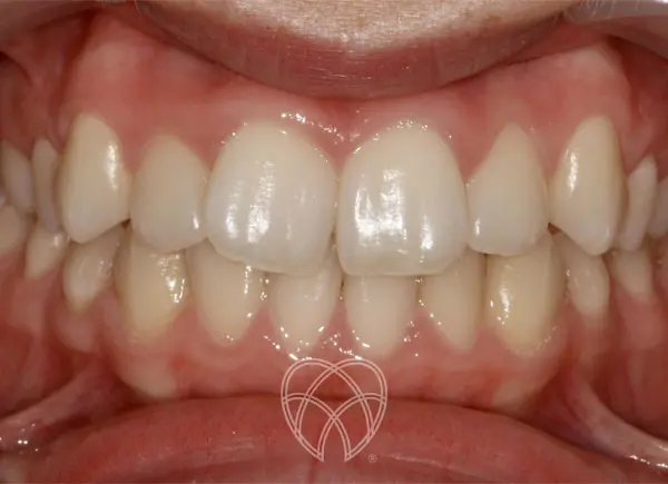 New Ash Green Dental - Invisalign Before2