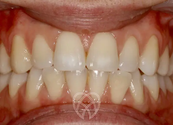 New Ash Green Dental - Invisalign Before5