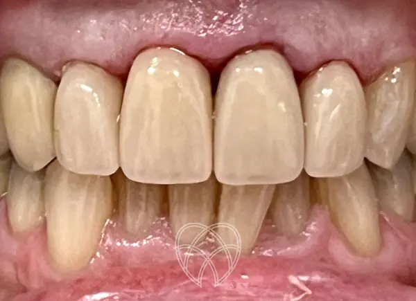 New Ash Green Dental - Porcelain Veneers After 2