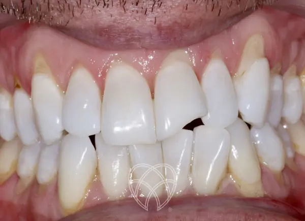 New Ash Green Dental - Teeth Whitening After 1