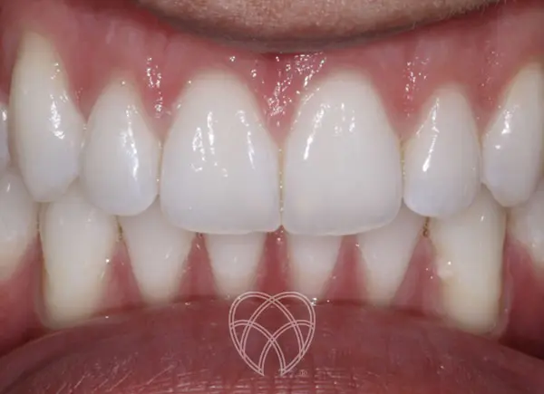 New Ash Green Dental - Teeth Whitening After 2