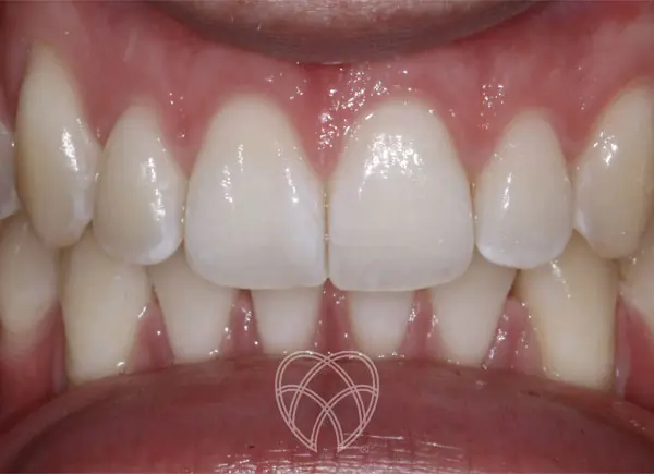 New Ash Green Dental - Teeth Whitening Before 2