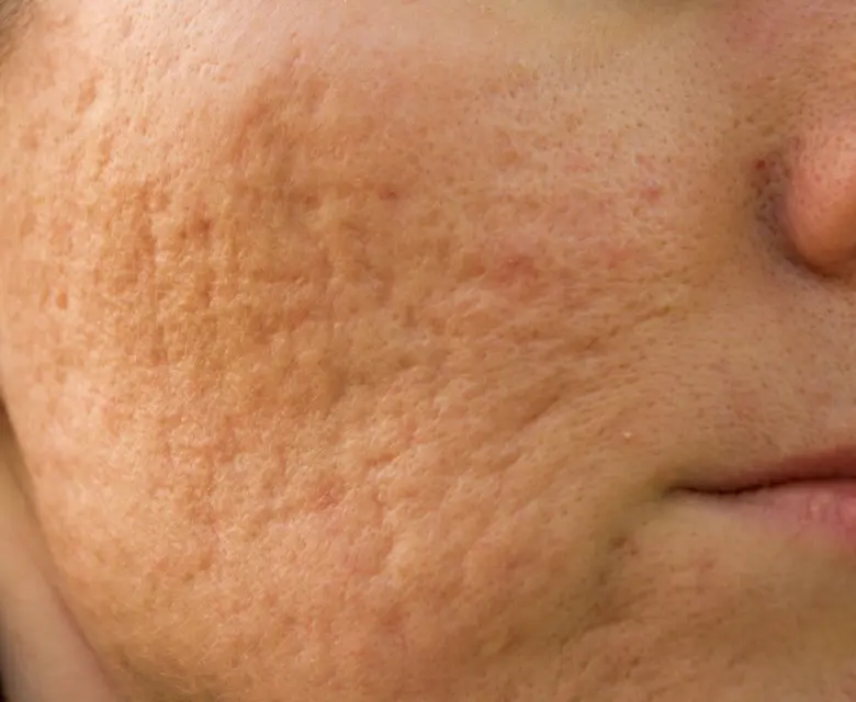 Acne & Acne Scarring Kent